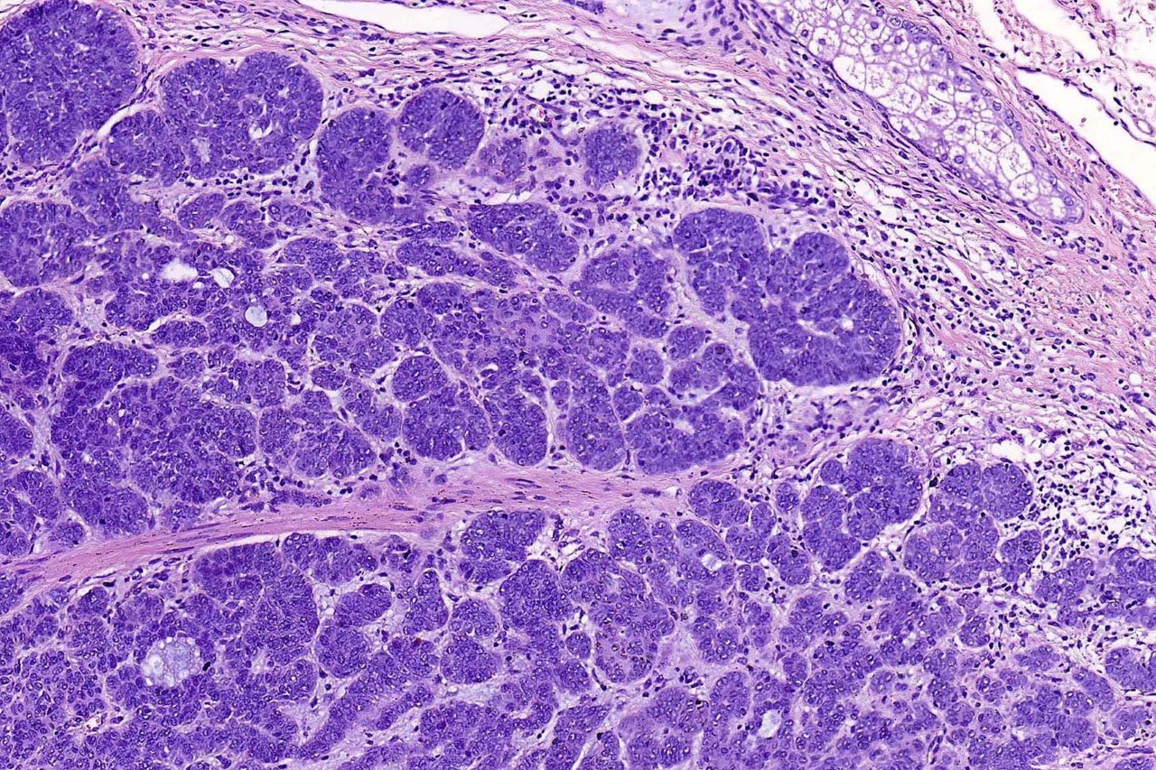 Pathology outlines - dentinogenic ghost cell tumor